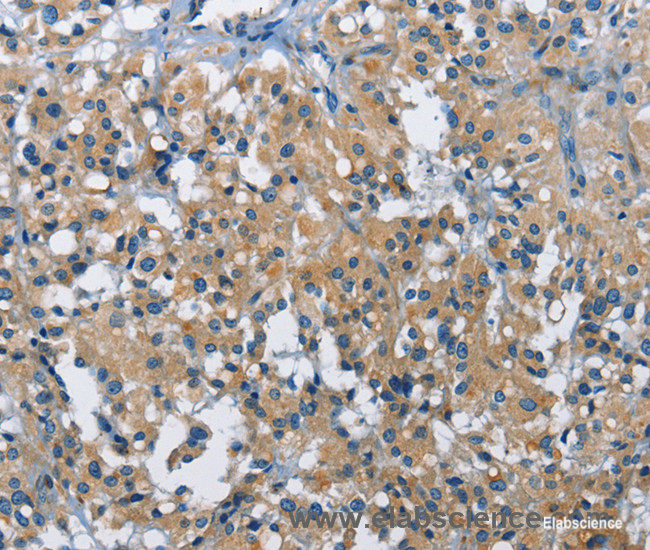 Immunohistochemistry of paraffin-embedded Human thyroid cancer tissue using BMPR1B Polyclonal Antibody at dilution 1:30