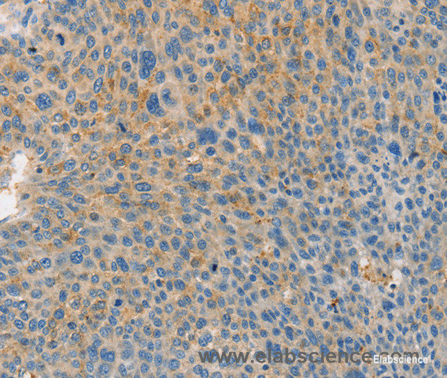 Immunohistochemistry of paraffin-embedded Human liver cancer tissue using BRCA1 Polyclonal Antibody at dilution 1:35