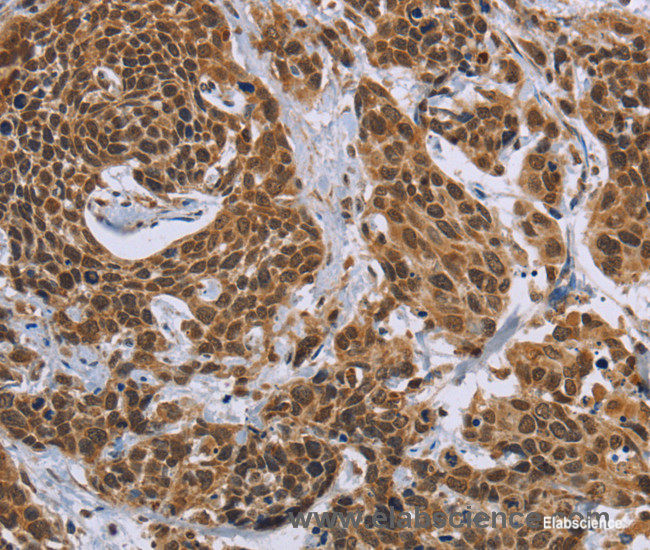 Immunohistochemistry of paraffin-embedded Human cervical cancer tissue using CCL21 Polyclonal Antibody at dilution 1:40