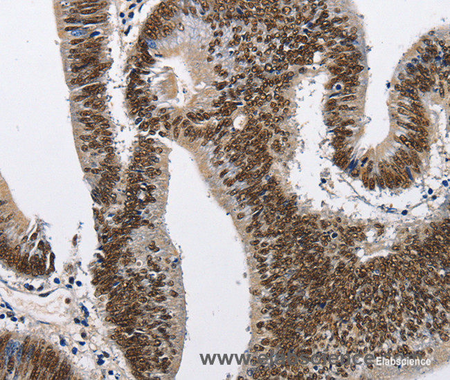 Immunohistochemistry of paraffin-embedded Human colon cancer tissue using CMTM2 Polyclonal Antibody at dilution 1:60