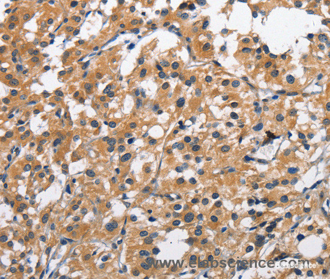 Immunohistochemistry of paraffin-embedded Human thyroid cancer tissue using CLEC2D Polyclonal Antibody at dilution 1:70
