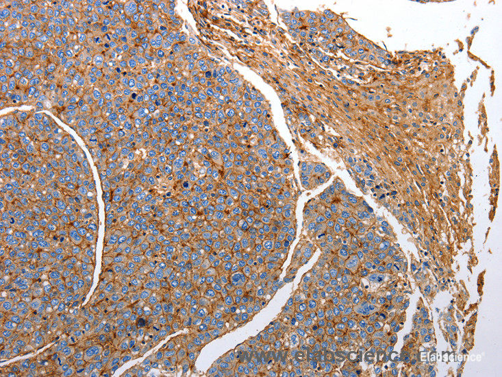 Immunohistochemistry of paraffin-embedded Human liver cancer tissue using CD151 Polyclonal Antibody at dilution 1:25