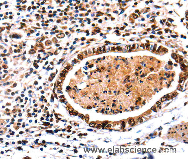 Immunohistochemistry of paraffin-embedded Human stomach cancer tissue using DNMT3A Polyclonal Antibody at dilution 1:65