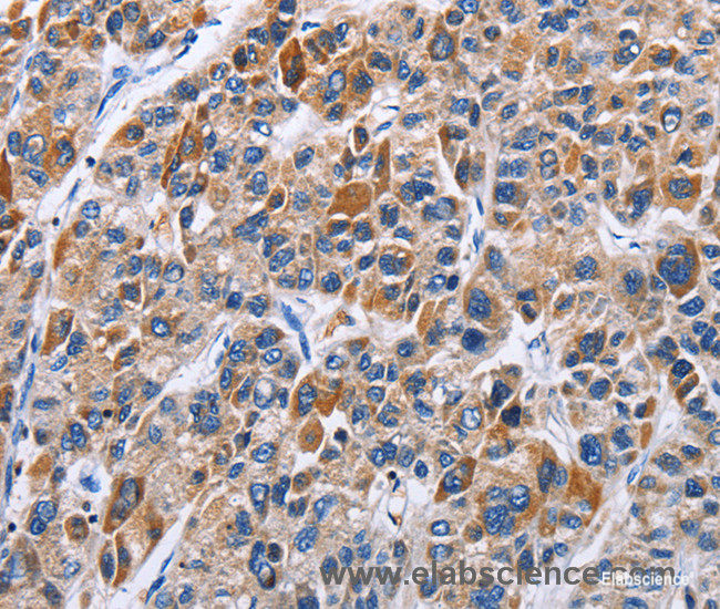 Immunohistochemistry of paraffin-embedded Human liver cancer tissue using ENPP5 Polyclonal Antibody at dilution 1:40