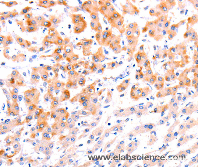 Immunohistochemistry of paraffin-embedded Human liver cancer tissue using Ephrin A1 Polyclonal Antibody at dilution 1:37
