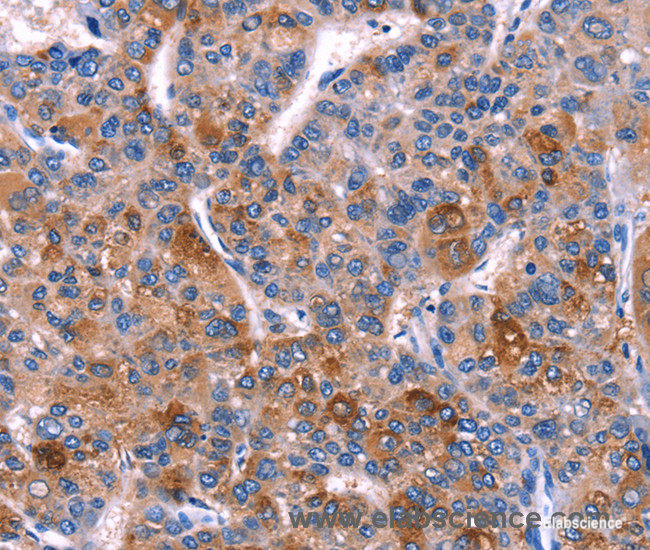 Immunohistochemistry of paraffin-embedded Human liver cancer tissue using DUSP13 Polyclonal Antibody at dilution 1:60