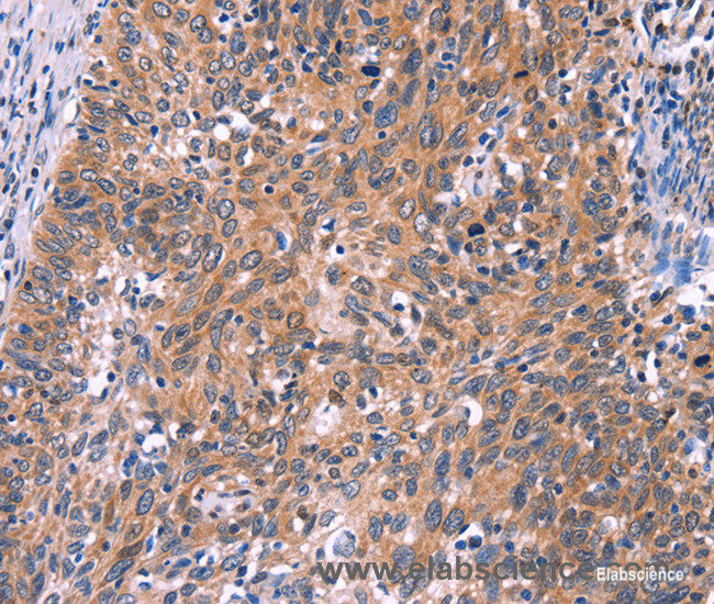 Immunohistochemistry of paraffin-embedded Human cervical cancer tissue using EDN1 Polyclonal Antibody at dilution 1:50
