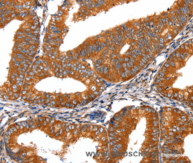 Immunohistochemistry of paraffin-embedded Human cervical cancer tissue using FGFR1 Polyclonal Antibody at dilution 1:60