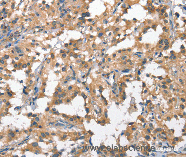 Immunohistochemistry of paraffin-embedded Human thyroid cancer tissue using HGF Polyclonal Antibody at dilution 1:65