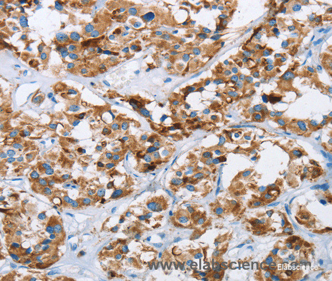 Immunohistochemistry of paraffin-embedded Human thyroid cancer tissue using HINT2 Polyclonal Antibody at dilution 1:40