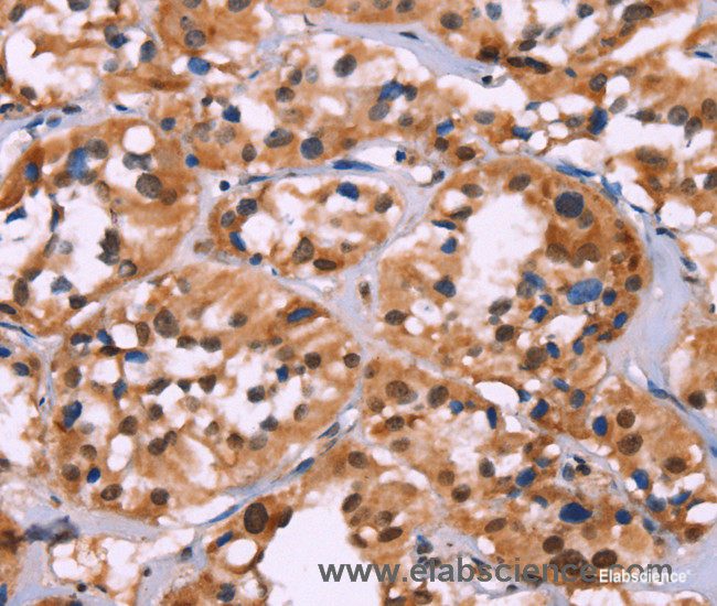 Immunohistochemistry of paraffin-embedded Human thyroid cancer tissue using HIST1H1C Polyclonal Antibody at dilution 1:70