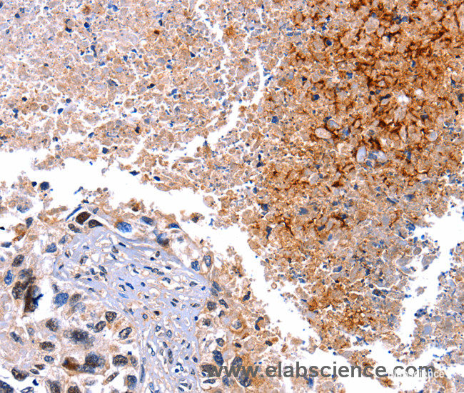 Immunohistochemistry of paraffin-embedded Human lung cancer tissue using HMOX1 Polyclonal Antibody at dilution 1:40
