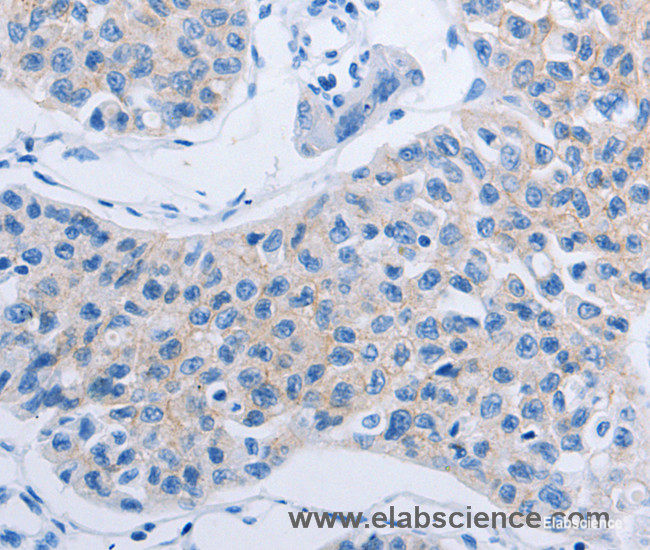 Immunohistochemistry of paraffin-embedded Human lung cancer tissue using HOXA6 Polyclonal Antibody at dilution 1:60
