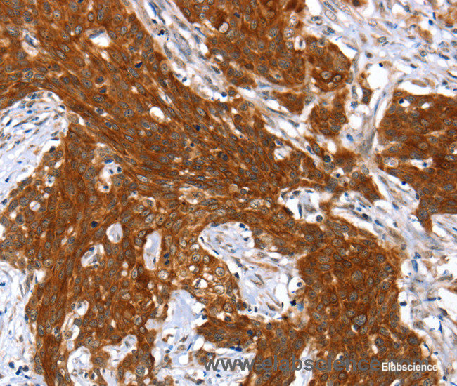 Immunohistochemistry of paraffin-embedded Human cervical cancer tissue using HOXB1 Polyclonal Antibody at dilution 1:40