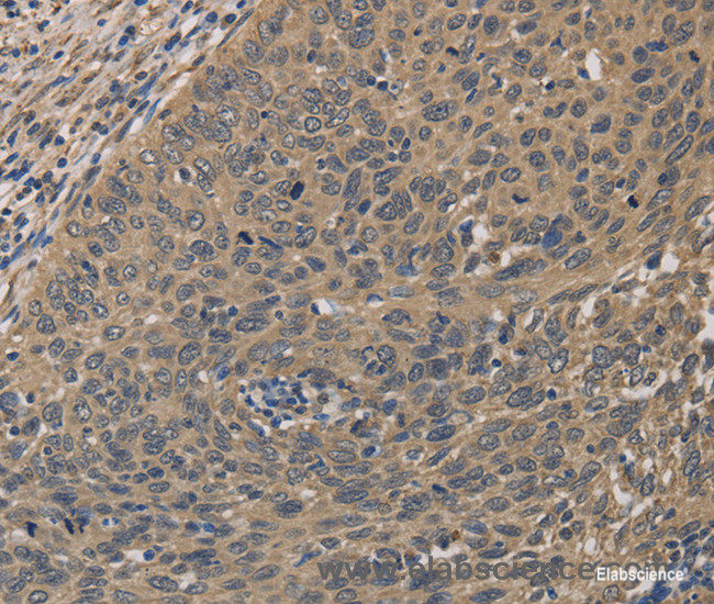 Immunohistochemistry of paraffin-embedded Human cervical cancer tissue using HSF1 Polyclonal Antibody at dilution 1:60