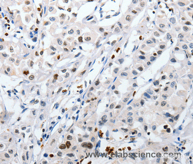 Immunohistochemistry of paraffin-embedded Human lung cancer tissue using HSPA1A Polyclonal Antibody at dilution 1:60