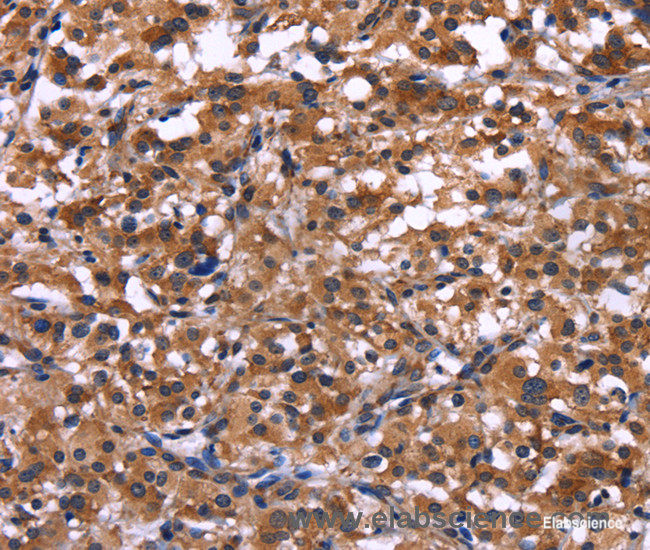 Immunohistochemistry of paraffin-embedded Human thyroid cancer tissue using IL1A Polyclonal Antibody at dilution 1:40