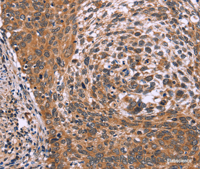 Immunohistochemistry of paraffin-embedded Human cervical cancer tissue using ING2 Polyclonal Antibody at dilution 1:60