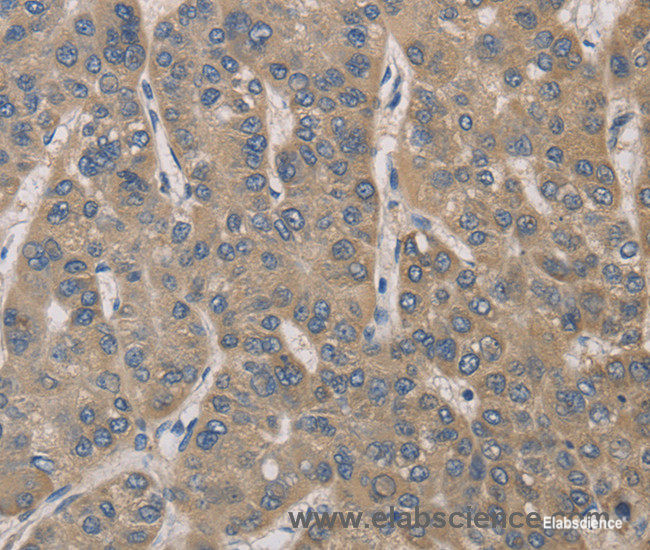 Immunohistochemistry of paraffin-embedded Human liver cancer tissue using IRAK4 Polyclonal Antibody at dilution 1:40