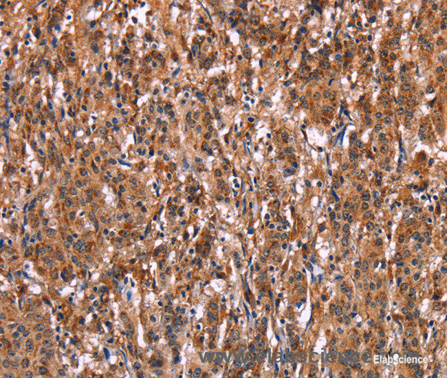 Immunohistochemistry of paraffin-embedded Human gasrtic cancer tissue using LILRB1 Polyclonal Antibody at dilution 1:50