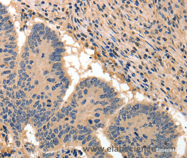 Immunohistochemistry of paraffin-embedded Human colon cancer tissue using BAIAP2 Polyclonal Antibody at dilution 1:50