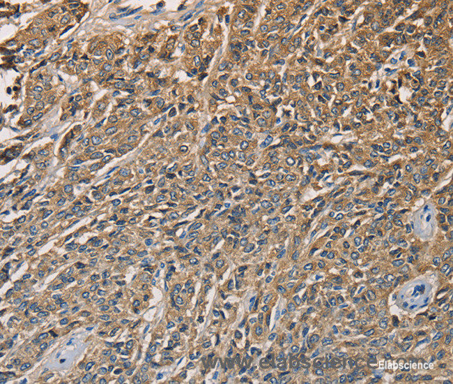 Immunohistochemistry of paraffin-embedded Human prostate cancer tissue using KLK1 Polyclonal Antibody at dilution 1:40