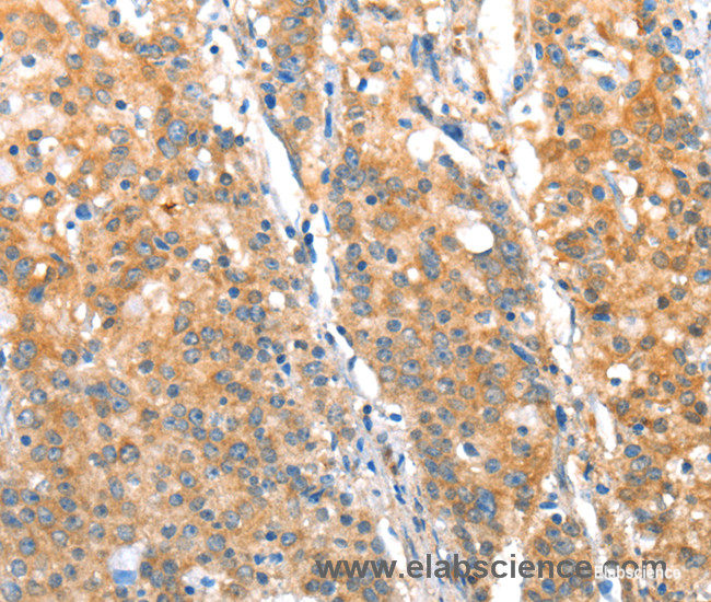 Immunohistochemistry of paraffin-embedded Human gasrtic cancer tissue using ST14 Polyclonal Antibody at dilution 1:70