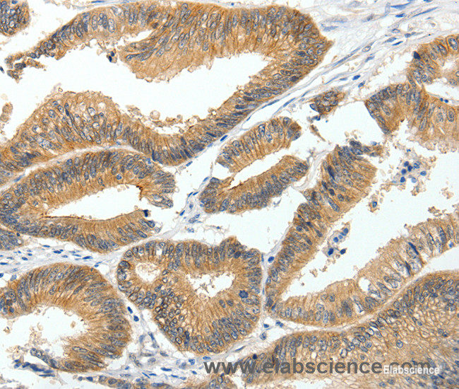Immunohistochemistry of paraffin-embedded Human colon cancer tissue using MDK Polyclonal Antibody at dilution 1:60
