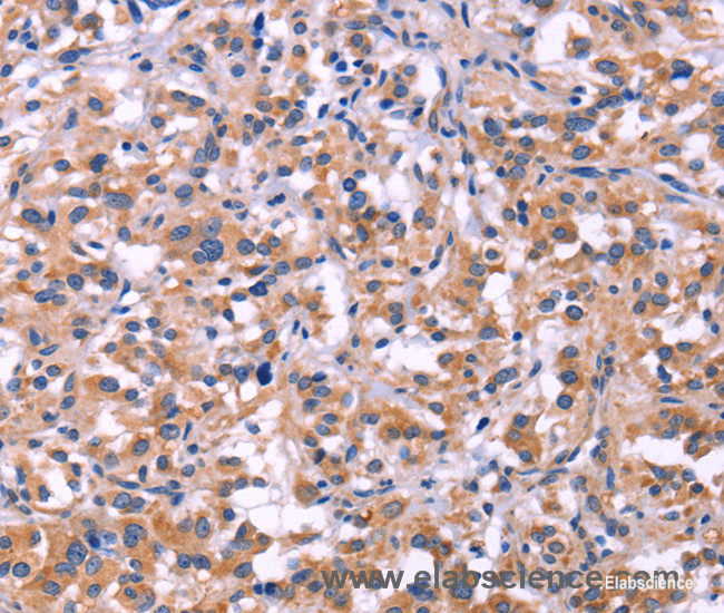Immunohistochemistry of paraffin-embedded Human thyroid cancer tissue using MMP14 Polyclonal Antibody at dilution 1:40