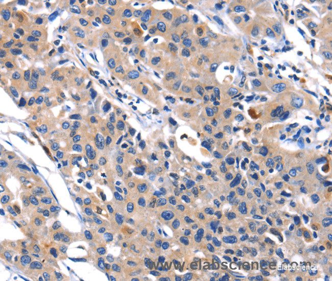 Immunohistochemistry of paraffin-embedded Human lung cancer tissue using MMP16 Polyclonal Antibody at dilution 1:40