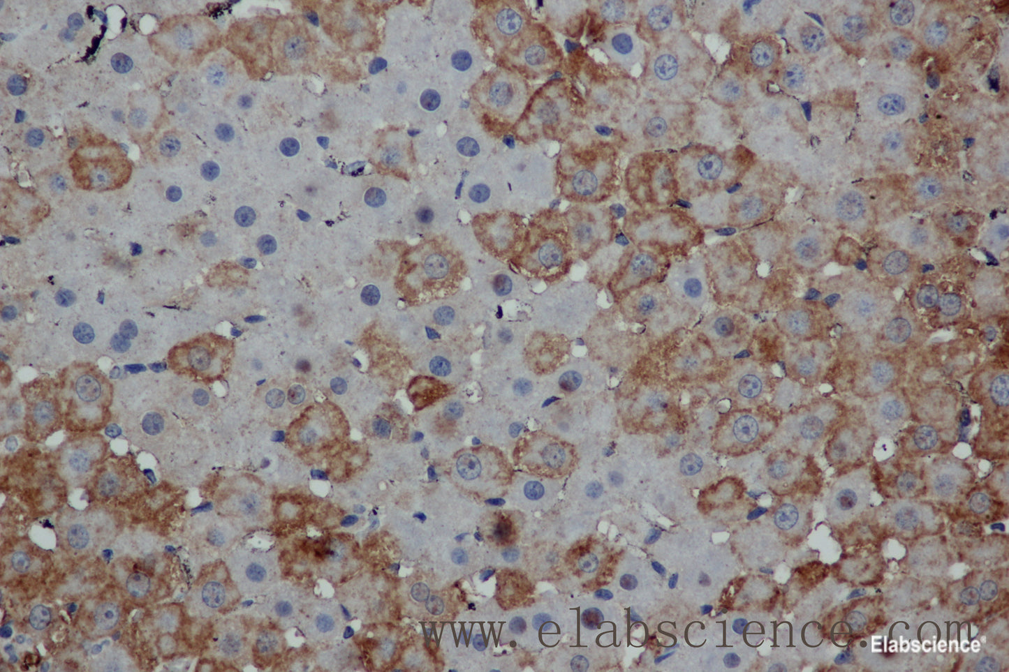 Immunohistochemistry of paraffin-embedded Human thyroid cancer tissue using MPO Polyclonal Antibody at dilution 1:50