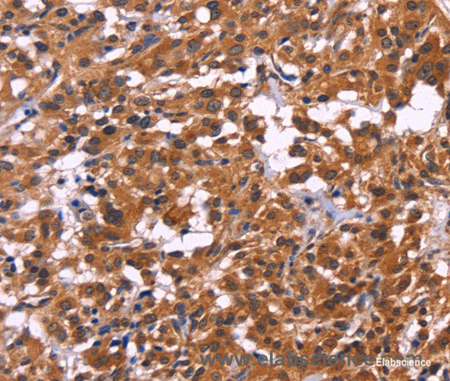 Immunohistochemistry of paraffin-embedded Human thyroid cancer tissue using MSH4 Polyclonal Antibody at dilution 1:30