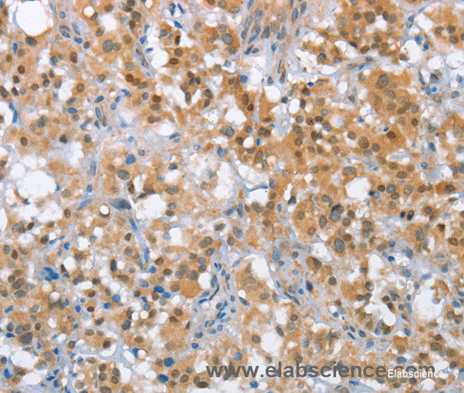 Immunohistochemistry of paraffin-embedded Human thyroid cancer tissue using MLH1 Polyclonal Antibody at dilution 1:65