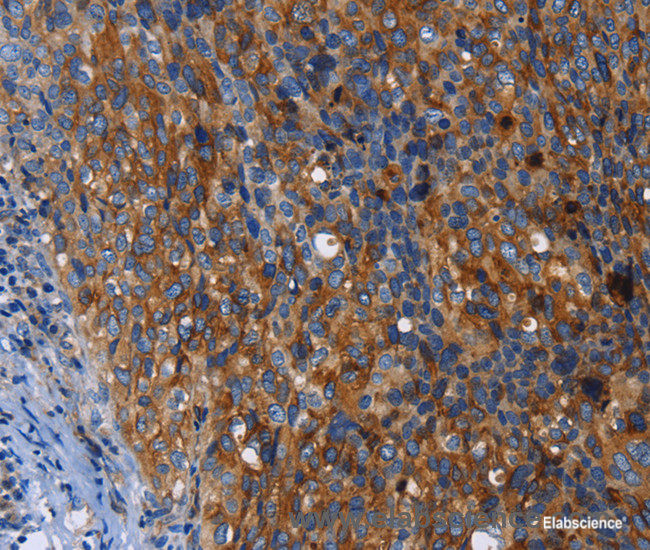 Immunohistochemistry of paraffin-embedded Human cervical cancer tissue using MSLN Polyclonal Antibody at dilution 1:50