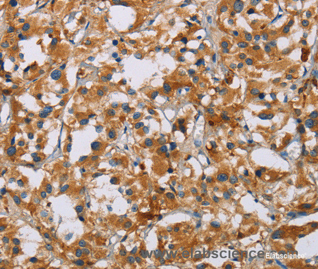Immunohistochemistry of paraffin-embedded Human thyroid cancer tissue using NRN1 Polyclonal Antibody at dilution of 1:40