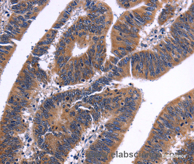 Immunohistochemistry of paraffin-embedded Human colon cancer tissue using NFATC3 Polyclonal Antibody at dilution 1:50