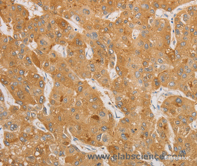 Immunohistochemistry of paraffin-embedded Human liver cancer tissue using NGF Polyclonal Antibody at dilution 1:50