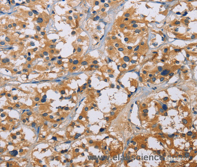 Immunohistochemistry of paraffin-embedded Human thyroid cancer tissue using NME5 Polyclonal Antibody at dilution 1:50