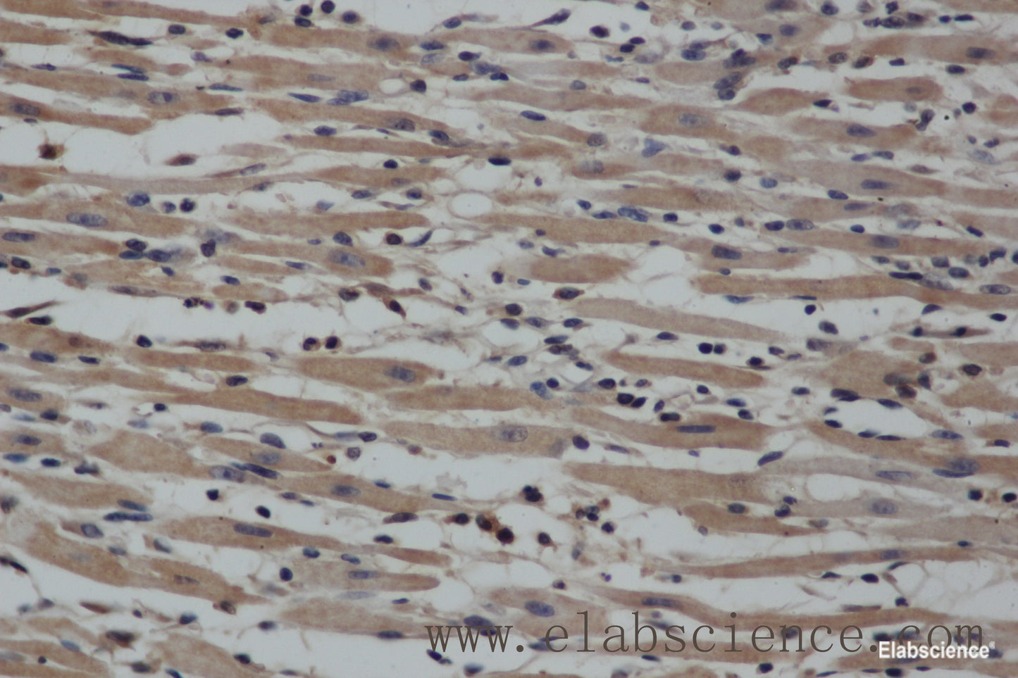 Immunohistochemistry of paraffin-embedded Human gasrtic cancer tissue using NOS2 Polyclonal Antibody at dilution 1:40
