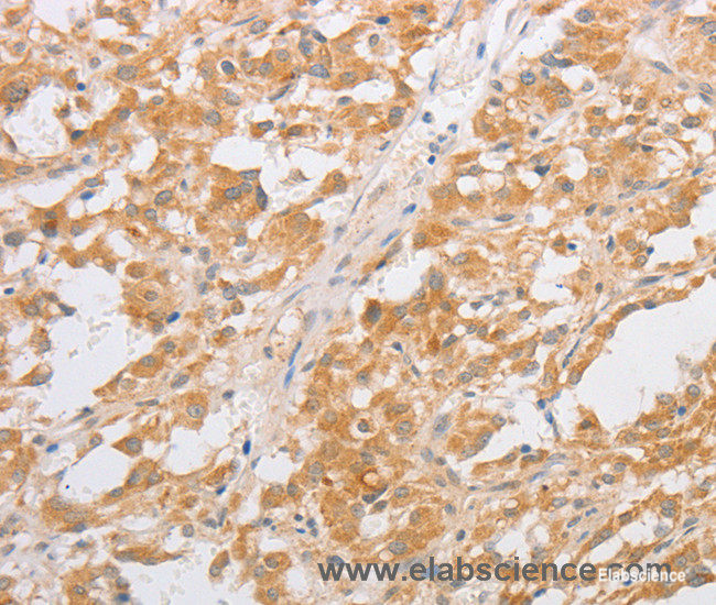 Immunohistochemistry of paraffin-embedded Human thyroid cancer tissue using CDKN2AIP Polyclonal Antibody at dilution 1:40