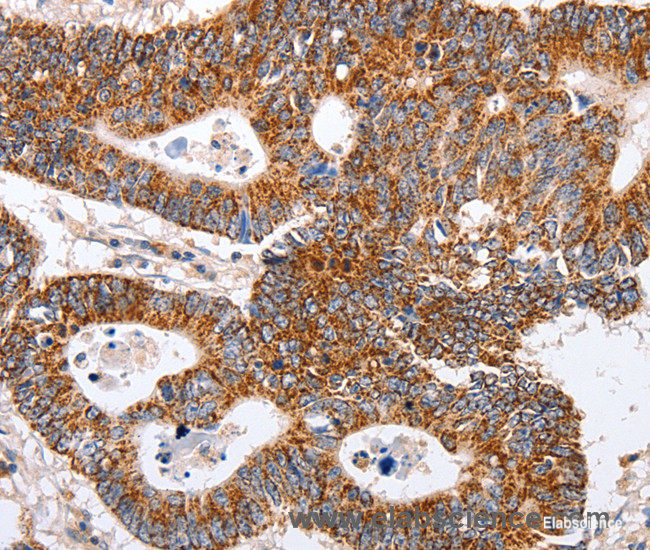 Immunohistochemistry of paraffin-embedded Human colon cancer tissue using MAP2K5 Polyclonal Antibody at dilution 1:40