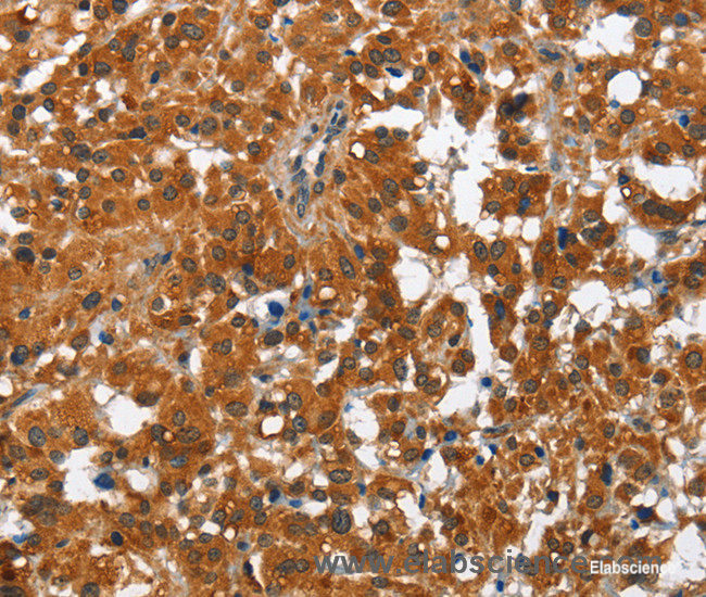 Immunohistochemistry of paraffin-embedded Human thyroid cancer tissue using PAK2 Polyclonal Antibody at dilution 1:50