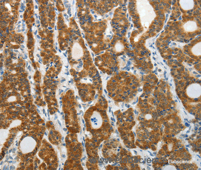 Immunohistochemistry of paraffin-embedded Human thyroid cancer tissue using PRDX5 Polyclonal Antibody at dilution 1:40