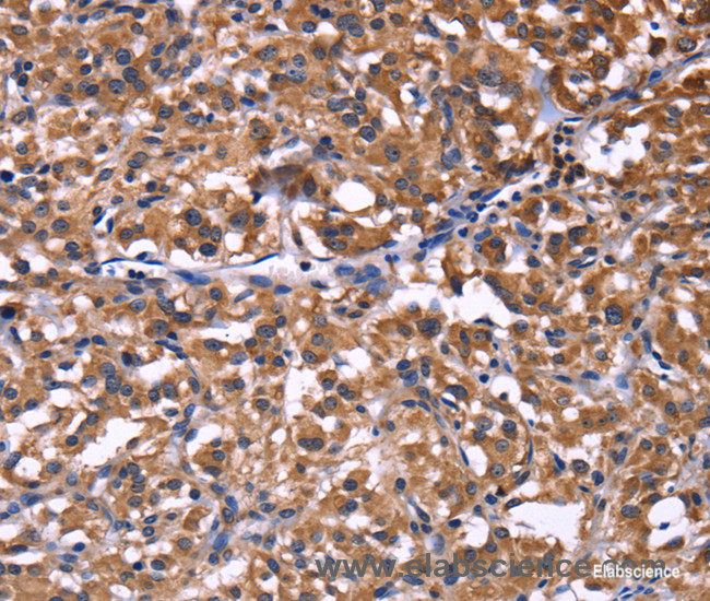 Immunohistochemistry of paraffin-embedded Human thyroid cancer tissue using SELPLG Polyclonal Antibody at dilution 1:50