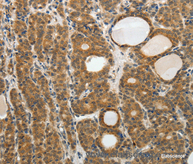 Immunohistochemistry of paraffin-embedded Human thyroid cancer tissue using RARA Polyclonal Antibody at dilution 1:40