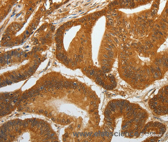 Immunohistochemistry of paraffin-embedded Human colon cancer tissue using RETNLB Polyclonal Antibody at dilution 1:40