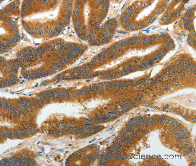 Immunohistochemistry of paraffin-embedded Human colon cancer tissue using RGS2 Polyclonal Antibody at dilution 1:40