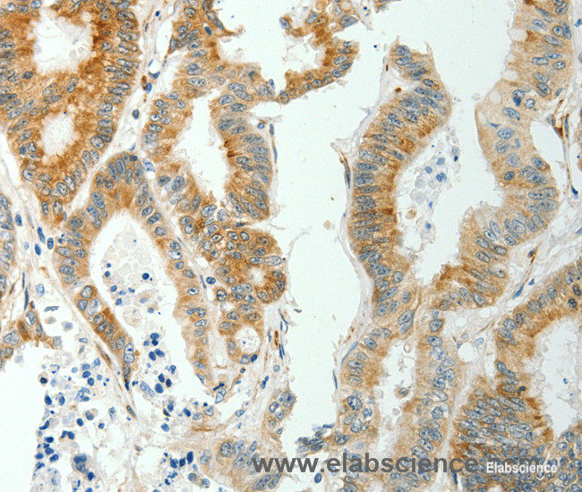 Immunohistochemistry of paraffin-embedded Human colon cancer tissue using SELENOM Polyclonal Antibody at dilution 1:50
