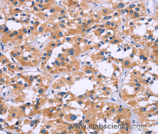 Immunohistochemistry of paraffin-embedded Human thyroid cancer tissue using ZEB2 Polyclonal Antibody at dilution 1:60