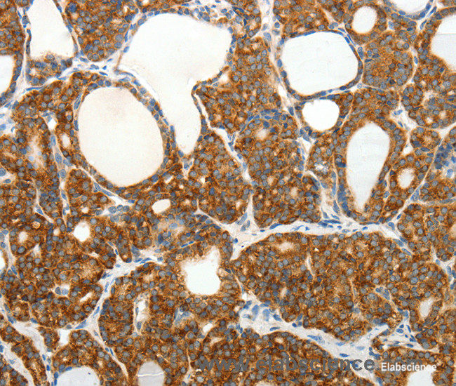 Immunohistochemistry of paraffin-embedded Human thyroid cancer tissue using SLC12A4 Polyclonal Antibody at dilution 1:30